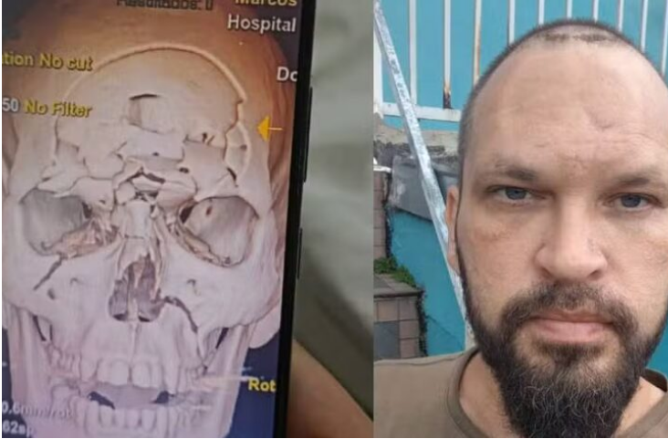 Crânio de motociclista é triturado em batida no Paraná e ele se recupera praticamente sem sequelas: 'Ficou tipo um quebra-cabeça'.