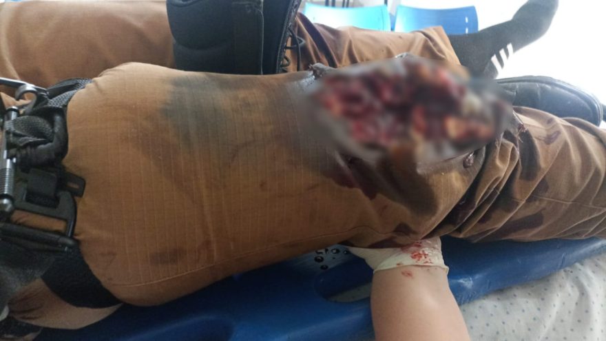 Policial feminina sofre ferimentos graves após disparo acidental de arma calibre .12